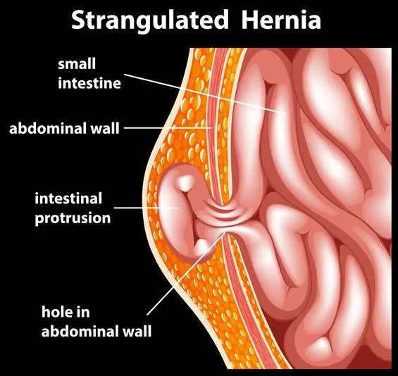 hernia strangulasi